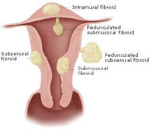 imagini fibromul uterin